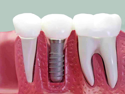 Implantes